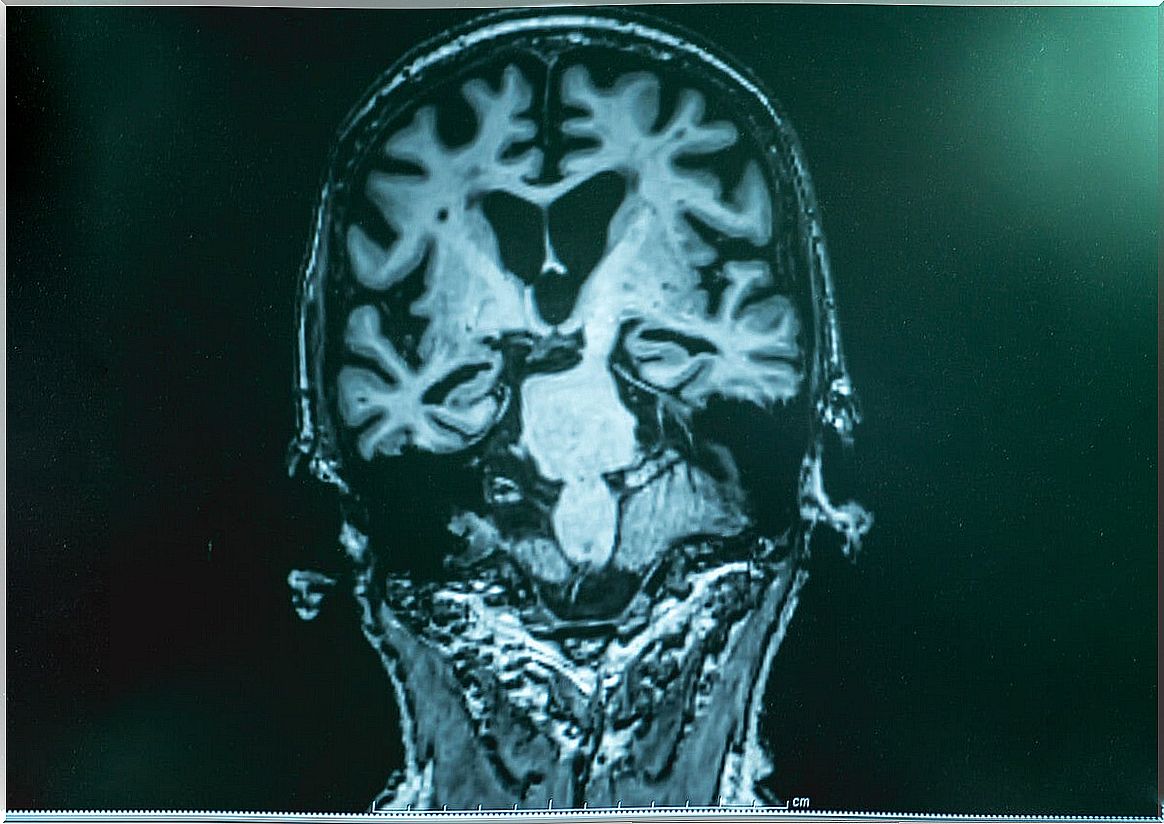 Brain of a person with Alzheimer's by magnetic resonance imaging